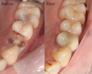 Before/After of an onlay carried out by our dentist John Odeny