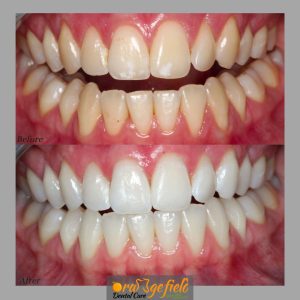 Amazing Teeth Whitening Results!